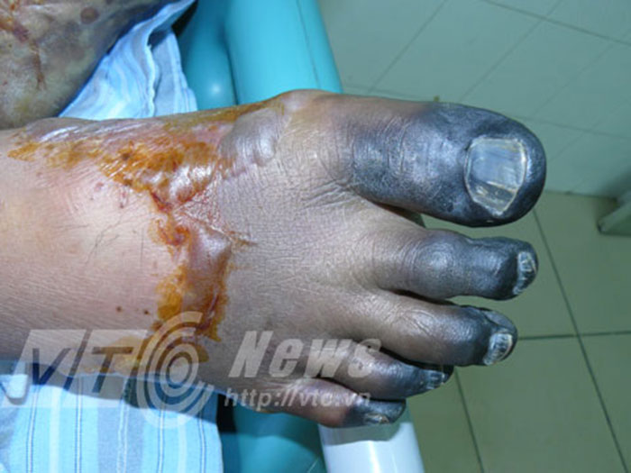 Đắng lòng ăn bát tiết canh - người đàn ông này phải cắt bỏ ngón chân hoại tử vì nhiễm trùng máu sau khi ăn tiết canh